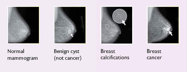 سرطان سینه خوش خیم