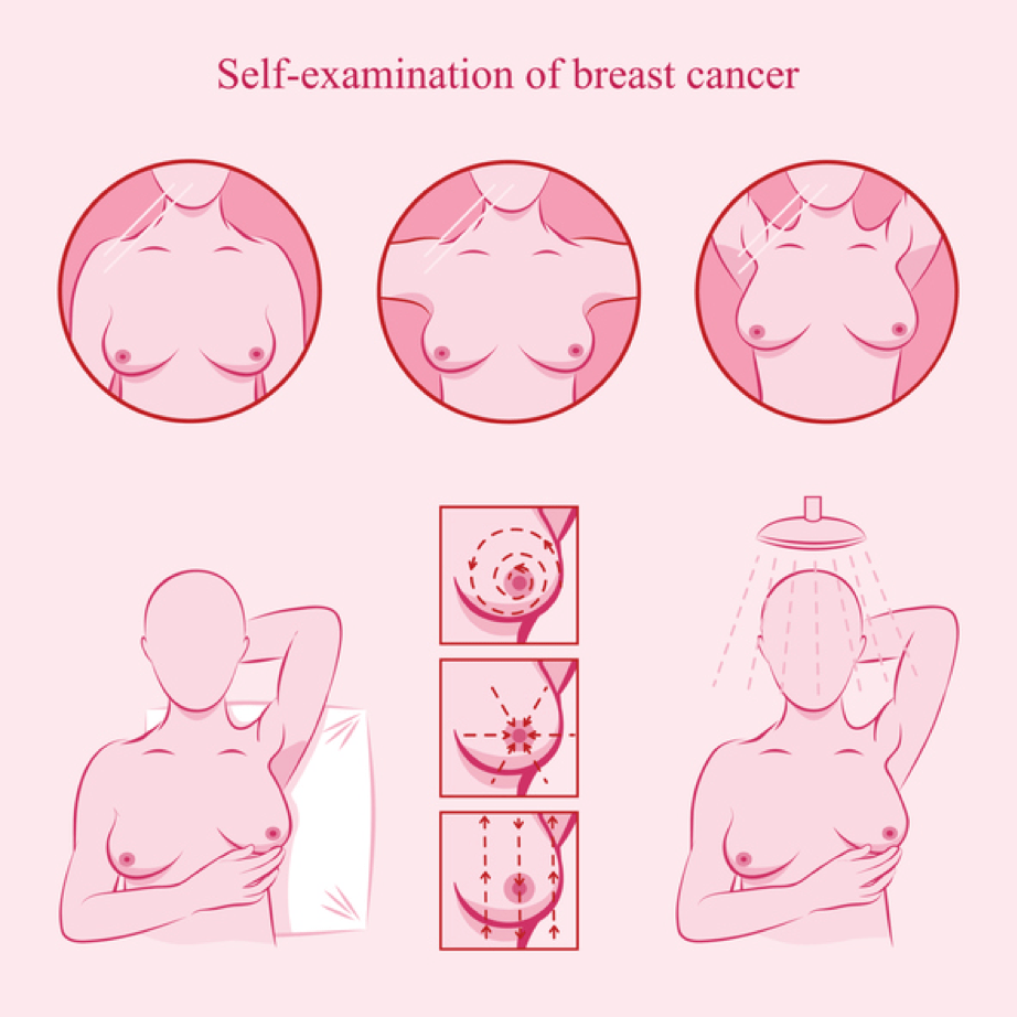 خودآزمایی سرطان سینه