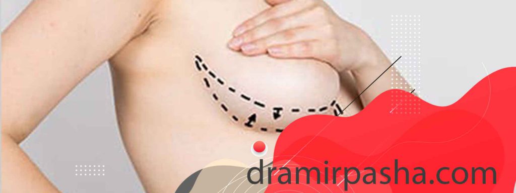 ماموپلاستی افزایشی
