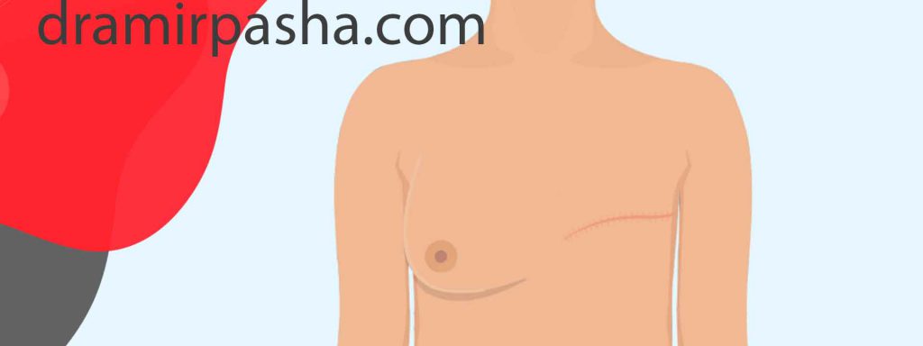 خطرات عمل برداشتن سینه در سرطان