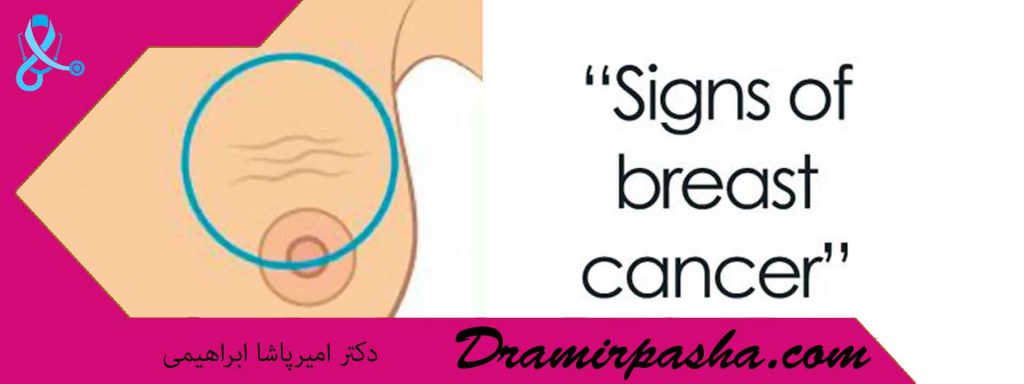 سرطان سینه چه علائمی دارد
