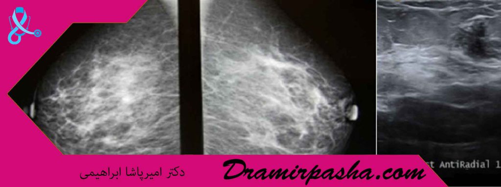 عکس سرطان سینه