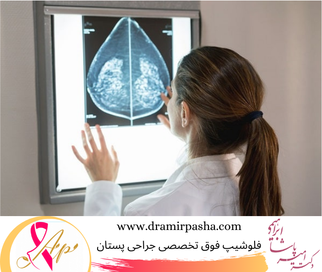 مراحل پیشرفت سرطان سینه