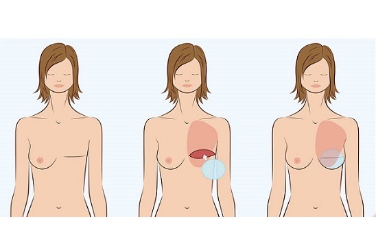 عمل زیبایی سینه و سرطان