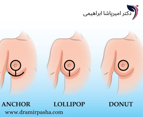 انواع برش در جراحی لیفت سینه