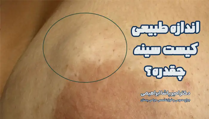 اندازه طبیعی کیست سینه