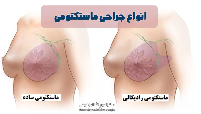 انواع جراحی ماستکتومی