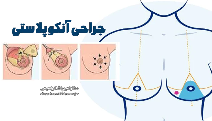 جراحی آنکوپلاستی