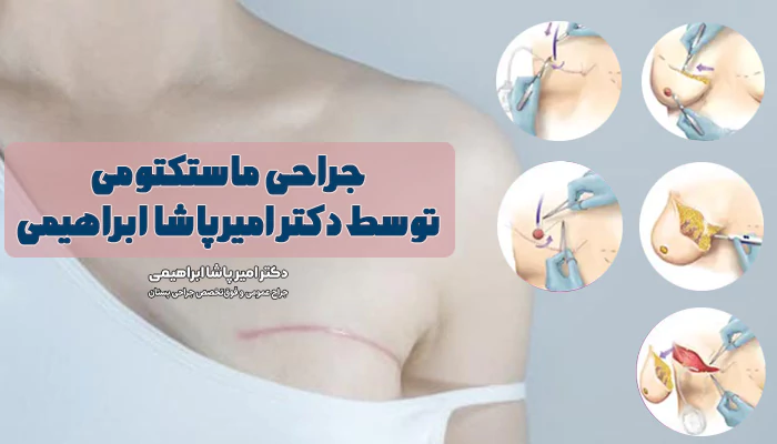 جراحی ماستکتومی