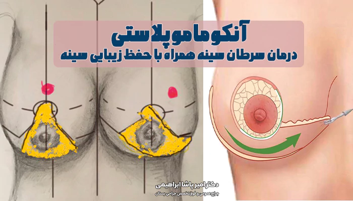 درمان سرطان سینه همراه با حفظ زیبایی سینه
