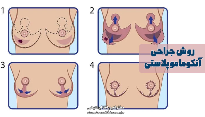 روش جراحی آنکوماموپلاستی