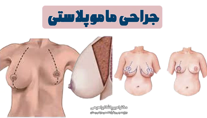عمل جراحی ماموپلاستی