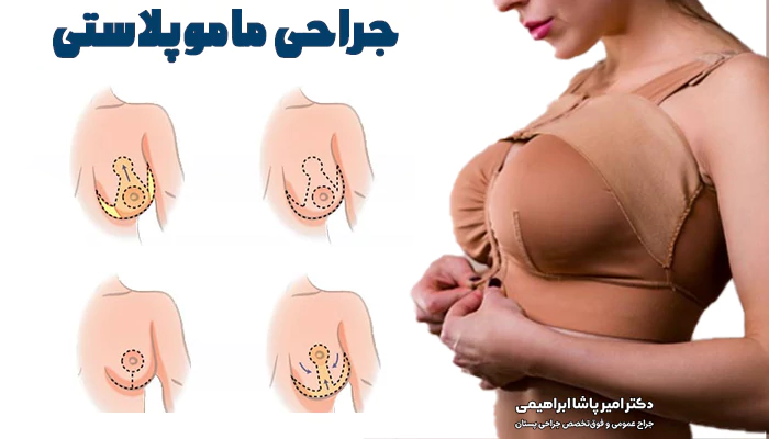 نحوه جراحی ماموپلاستی