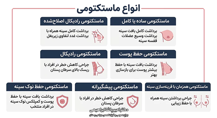 انواع ماستکتومی