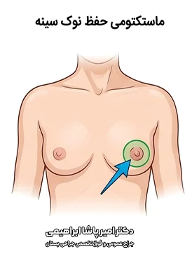 ماستکتومی حفظ نوک سینه