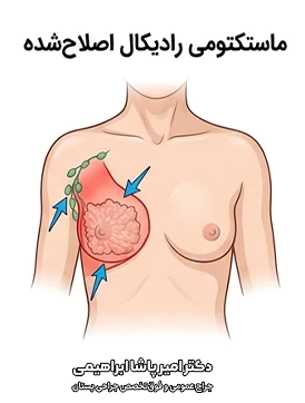 ماستکتومی رادیکال اصلاح شده
