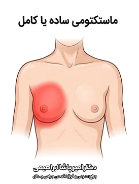 ماستکتومی ساده