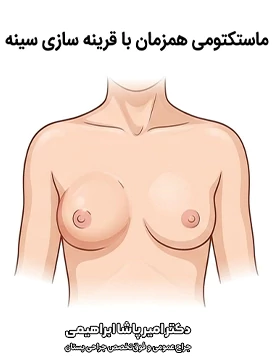 ماستکتومی همزمان با قرینه سازی سینه