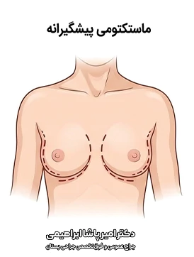 ماستکتومی پیشگیرانه