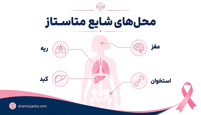 اینفوگرافیک محلهای شایع متاستاز سرطان سینه به استخوان، کبد، ریه و مغز