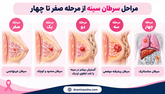 اینفوگرافیک از مراحل سرطان پستان
