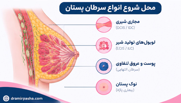 اینفوگرافیک از محا شیوع انواع سرطان سینه